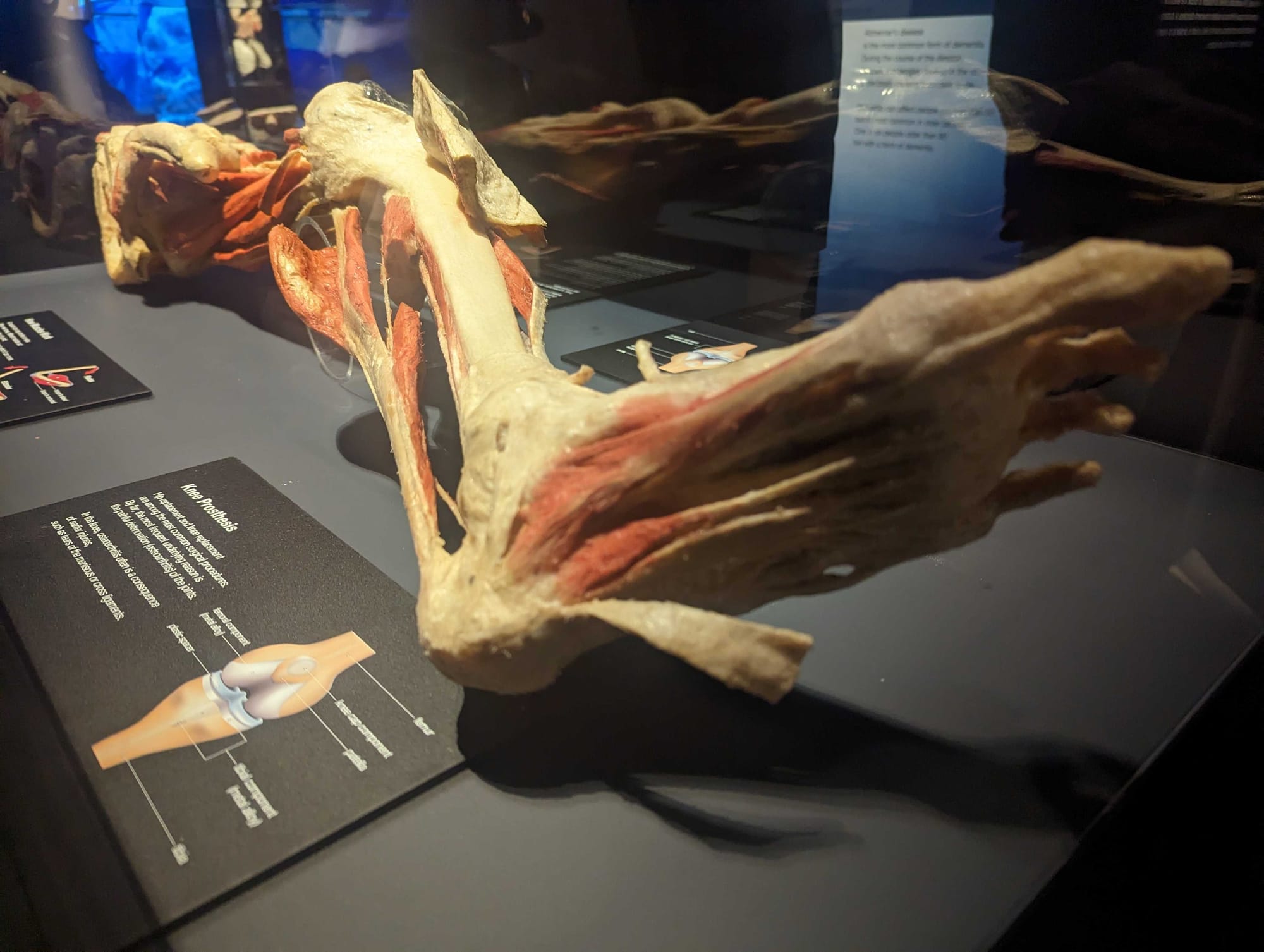 Whole-body plastinates and organs are displayed at the BODY WORLDS RX exhibition at Allentown's Da Vinci Science Center. The 