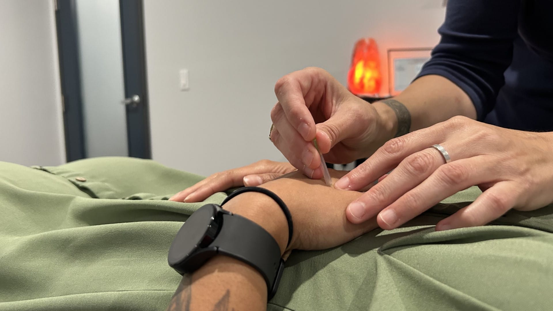 Acupuncture needle being placed in patient's hand.